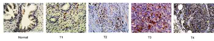 Elevated expression of TOPK is correlated with pathological grade in prostate cancer patients.