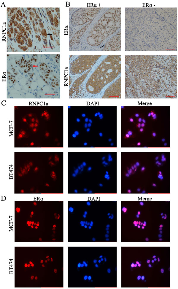 RNPC1 expression correlated with ER&#x3b1; positive human breast cancer.
