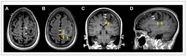 Patient with solitary breast cancer brain metastasis involving the posterior aspect of the left middle frontal gyrus.