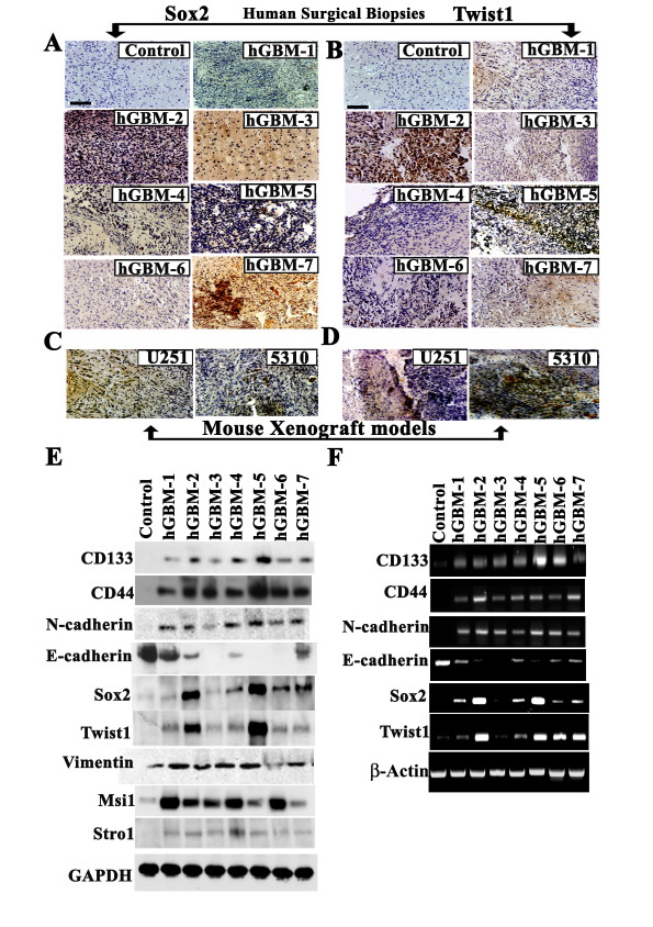 Primary glioblastoma tumors express mesenchymal makers Twist1 and Sox2 phenotype.