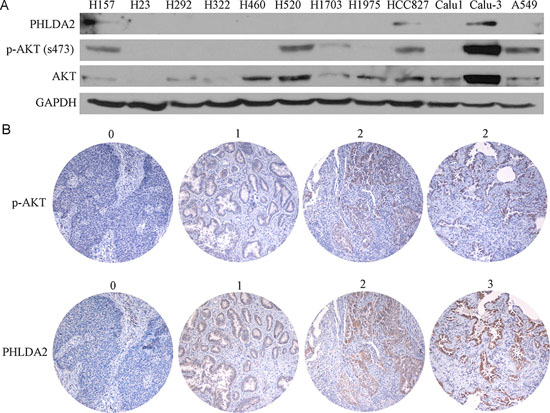 PHLDA2 protein expression correlates positively with AKT activation in lung cancer cell lines and human lung cancer tissue microarray.