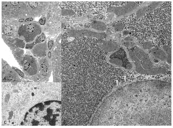 Electron microscopic features of diabetes related clear cell tubules (CCT).