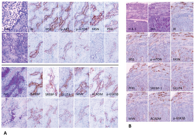 Representative immunohistochemistry in serial cryostat sections series of clear cell tubules (CCT) from streptozotocin-induced diabetic rats (A) and preneoplastic tubular lesions and renal carcinomas in rats after administration of N-Nitrosomorpholine (NNM) (B).
