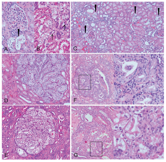Morphological aspects of human clear cell tubules (CCT) and advanced lesions.