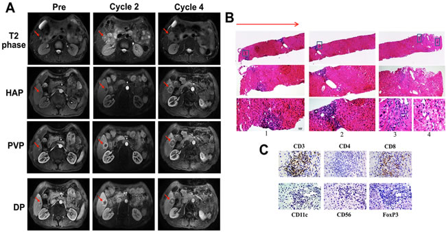 Image of a serial MRI scan and biopsy analysis of the liver tumor for patient UPN1 with disease stabilization.