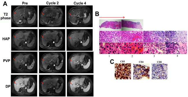 Image of MRI scan and biopsy analysis of the liver tumor for patient UPN2 before palliative local treatment.
