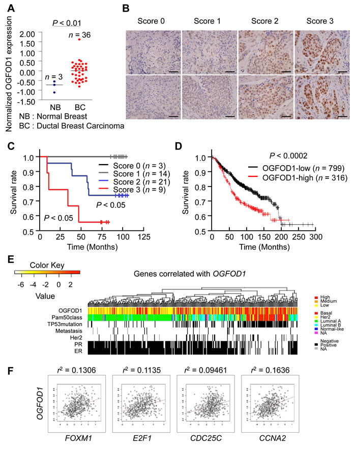 OGFOD1 is highly expressed in breast cancer tissues.