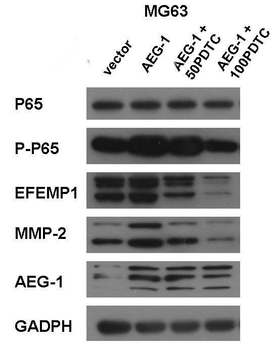 PDTC suppressed EFEMP1 expression via inhibition of NF-&#x3ba;B signaling pathway in osteosarcoma cells.
