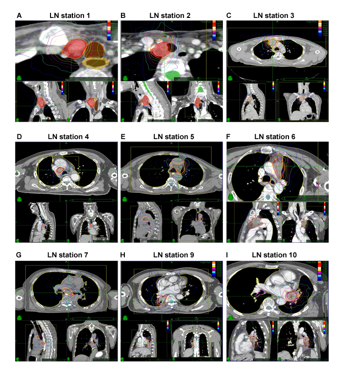 Representative planning CT and isodose distributions with SRT of patients with R/SP-MLNMs originating from NSCLC.