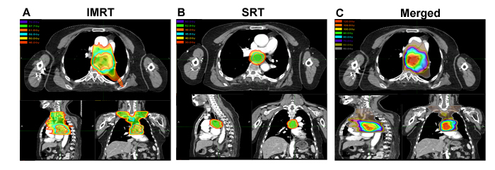 Analysis of SRT, IMRT, and the composite images for a representative patient.