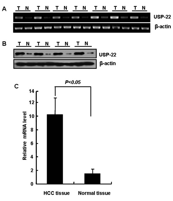 USP22 expression in HCC and normal liver tissues.