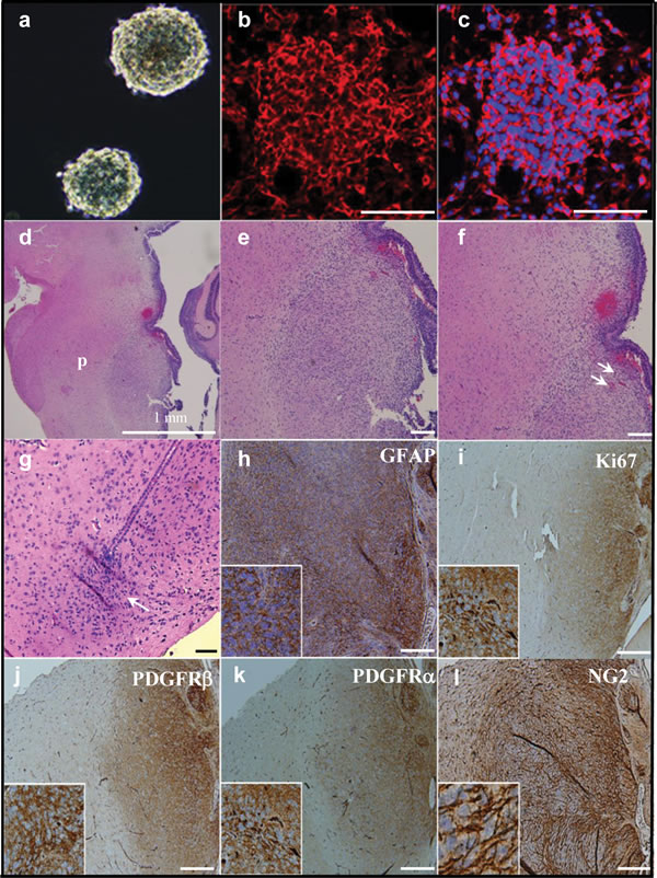 Orthotopic injection of NG2 expressing cells causes aggressive brainstem tumors