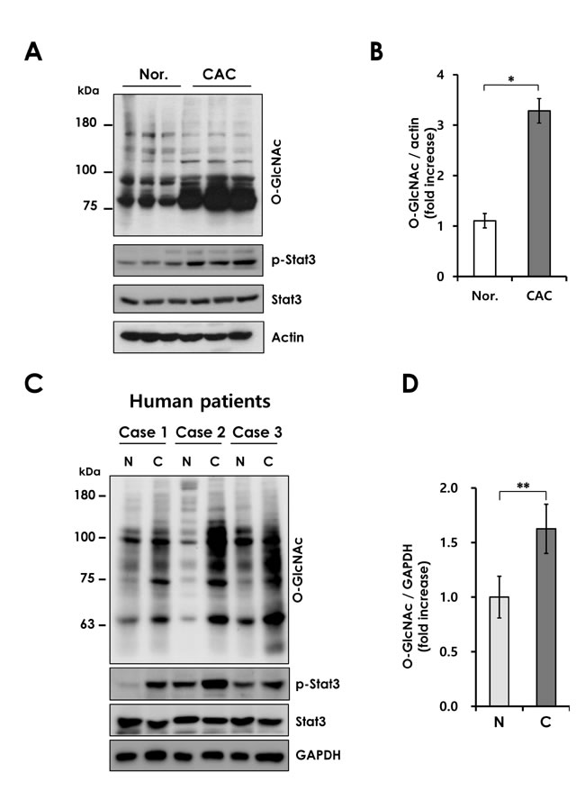 Elevated O-GlcNAcylation in mouse and human CAC.