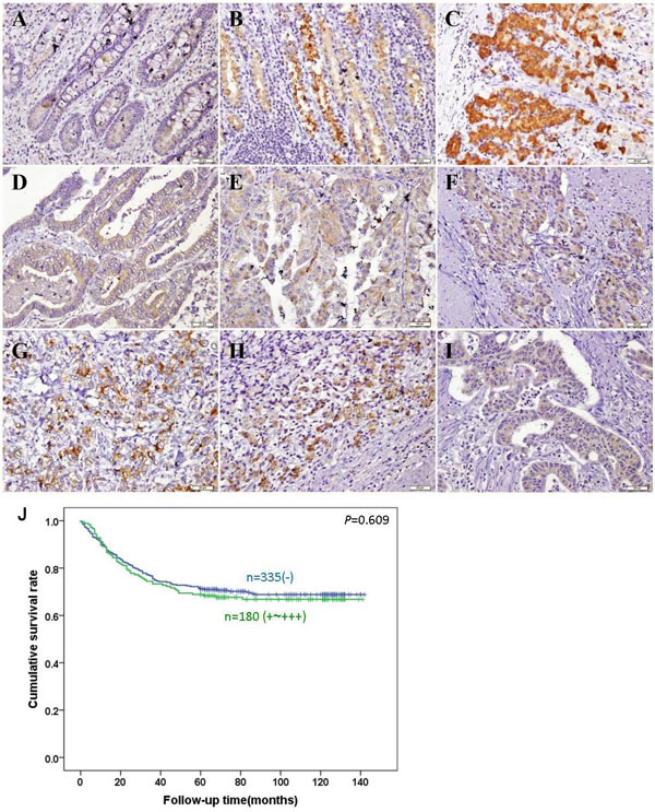 Immunohistochemical staining of BTG3 in gastric non-neoplastic mucosa and cancer.