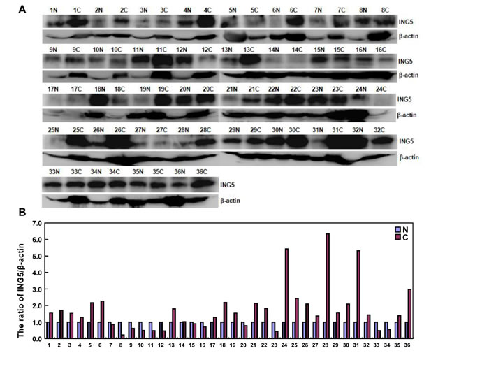 The relationship between ING5 expression and clinicopathological parameters of gastric cancers.