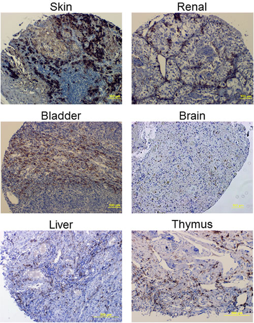 Example IHC images using the FR-&#x3b2; specific m909 antibody in various cancer tissues.