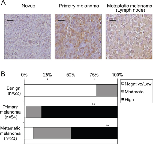 Expression levels of DTX3L in nevi and melanoma tissues in humans.