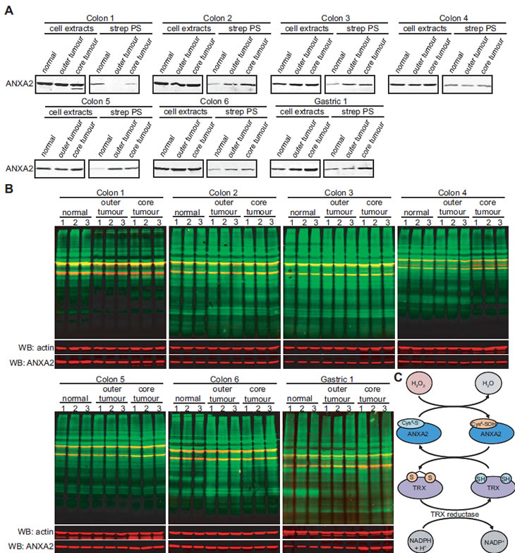 ANXA2 redox status in human normal and tumor tissues.