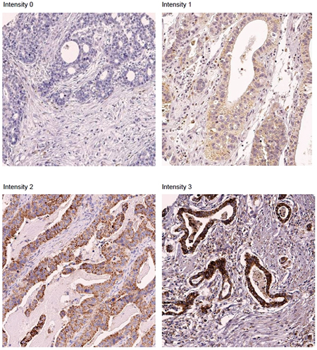 Representative sections showing MerTK overexpression on immunohistochemical studies. (&#x00D7; 200).