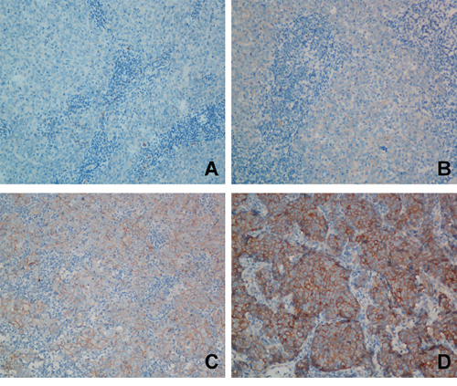 Representative images of immunohistochemical (IHC) staining for MET in locoregionally advanced nasopharyngeal carcinoma.