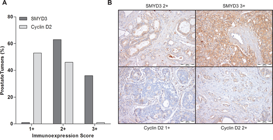 Immunoexpression of SMYD3 and Cyclin D2 in prostate cancer tissues.