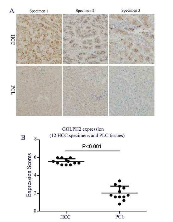 A. Identifcation of GOLPH2 expression in HCC specimens. HCC specimens and paracancerous liver (PCL) tissues collected from 12 HCC patients were fixed in 10% formalin prior to perform standard paraffin-embedded sections, and the expression of GOLPH2 was detected by the immunohistochemistry analysis.