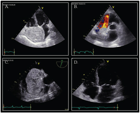 Echocardiography.