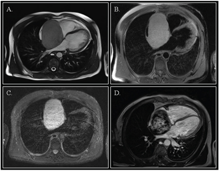 Cardiac magnetic resonance.