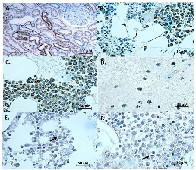 Klotho expression by multiple myeloma.