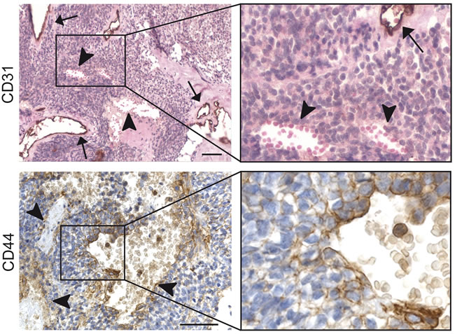 CD44 expression is related to presence of blood lakes in human Ewing sarcoma patient tissues.