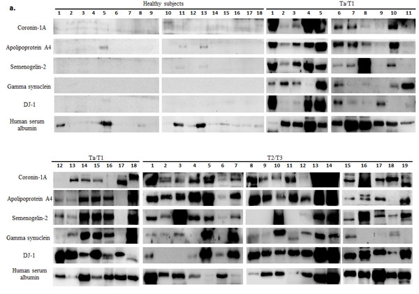 Western blot analysis of urine samples from healthy subjects and bladder carcinoma (BCa) patients.