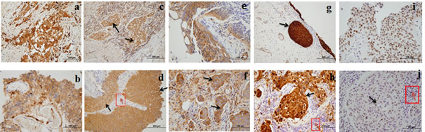 High expression of five biomarkers in bladder carcinoma (BCa) tissue.