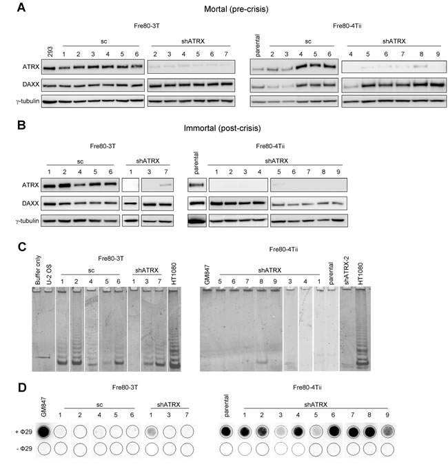 ATRX loss promotes ALT activation in breast fibroblasts.