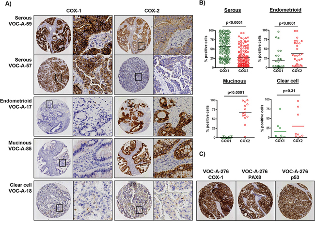 Differential protein expression of COX-1 and COX-2 in ovarian cancer histological subtypes.