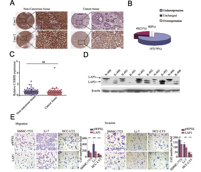 LAP1 represses HCC cell migration and invasion ability