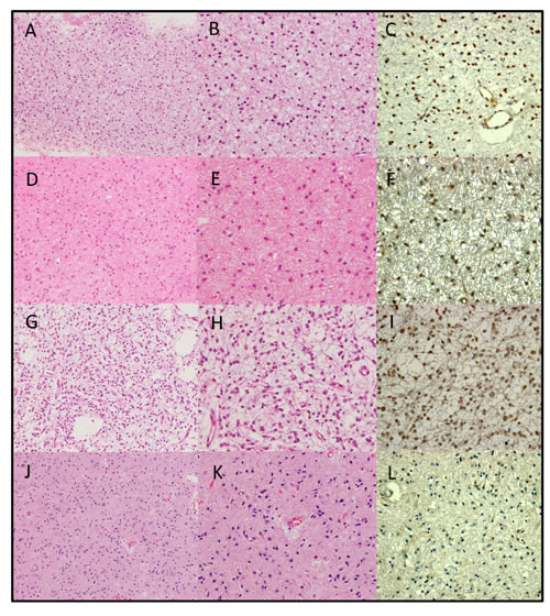 Hematoxylin and eosin staining (a, b, d, e, g, h, j, k) and ATRX staining (c, f, i, l) of examples of &#x201c;astrocytic&#x201d; gliomas with total 1p19q loss.