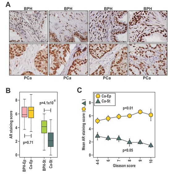 The expression of stromal AR is related to clinical parameters and outcomes of prostate cancer.