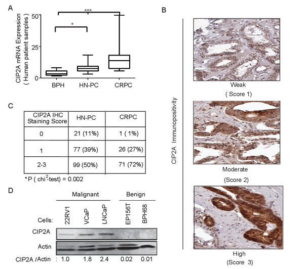 CIP2A is overexpressed in prostate cancer.
