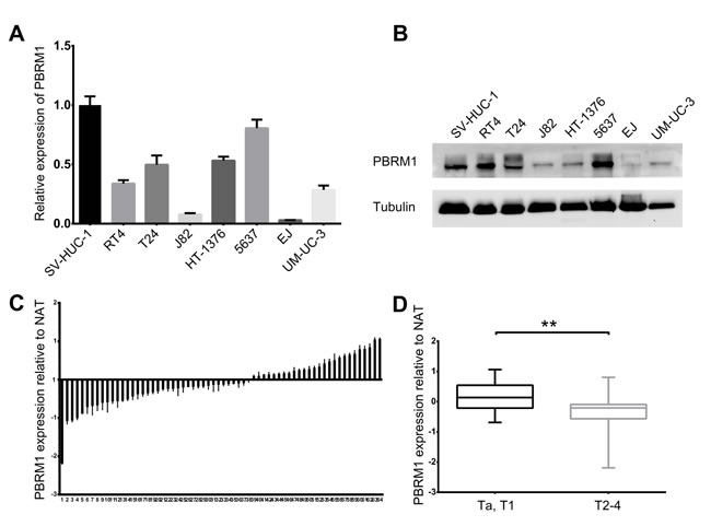 Reduced expression of PBRM1 in human bladder cancer cell lines and tissues.