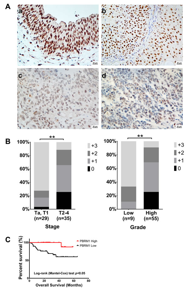 PBRM1 immunohistochemistry of bladder cancer tissue and its association with tumor stage, grade and overall survival.
