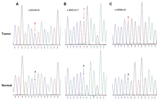 Exome sequencing of PBRM1 by Sanger sequence in bladder cancer tissues.