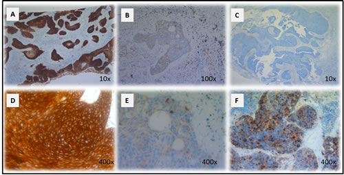 CD70 staining in primary NSCLC.