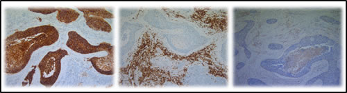 Representative IHC on serial cuts showing the expression of CD70, CD27 and FOXP3.
