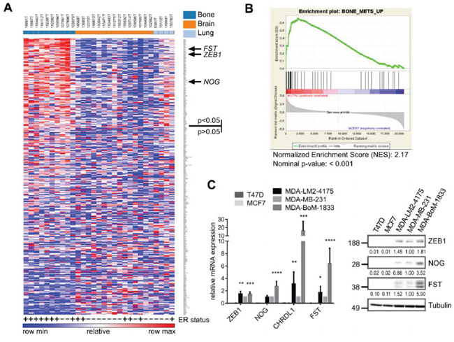 Genes positively regulated by ZEB1 are upregulated in breast cancer bone metastases.