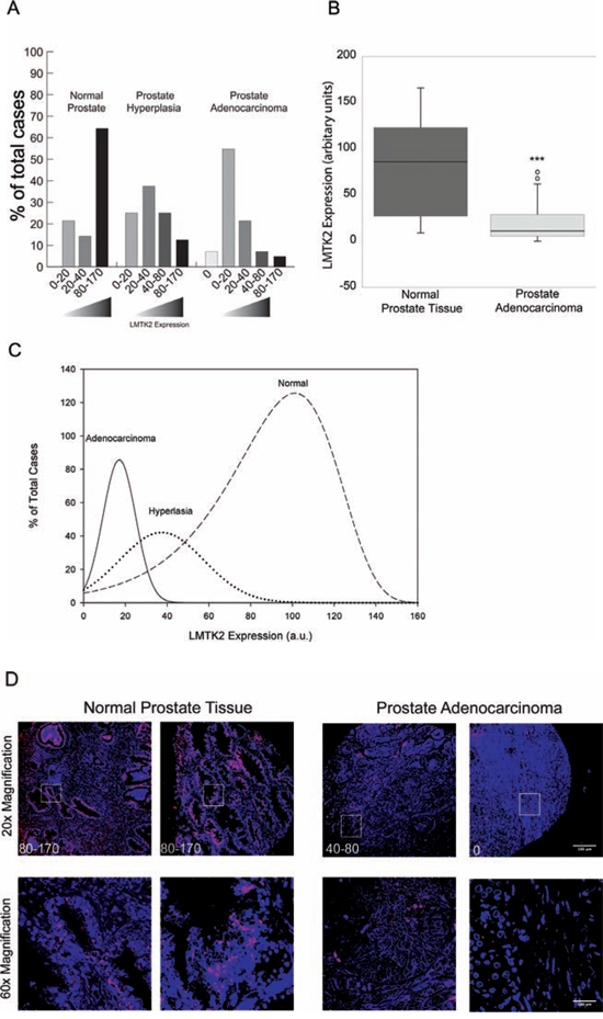 LMTK2 is down regulated in human prostate cancer.