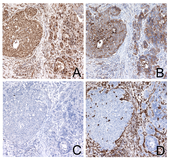 Immunohistochemical staining of a hypopharyngeal squamous cell carcinoma with high TWIST2 expression not associated to EMT.