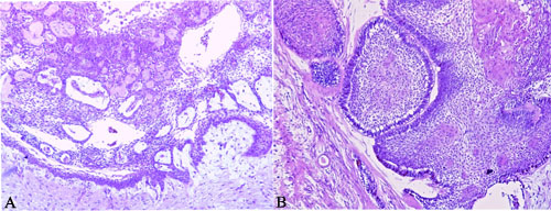 Histopathological picture of unicystic and multicystic ameloblastoma.