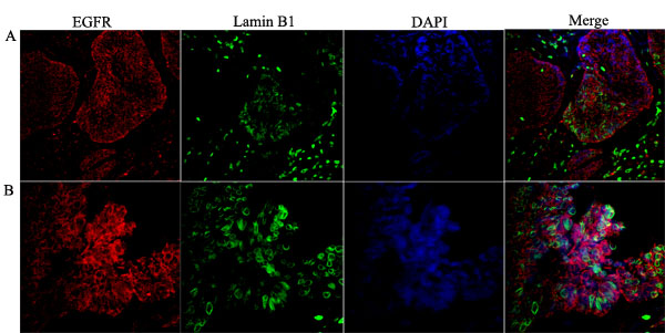 Co-localization of the nuclear EGFR with Lamin B1 in multicystic ameloblastoma.
