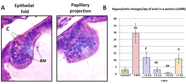 Histological hyperplastic changes in the prostate.