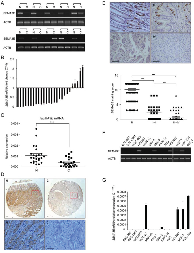 Sema3E is down-regulated in gastric cancer and gastric cancer cell lines.